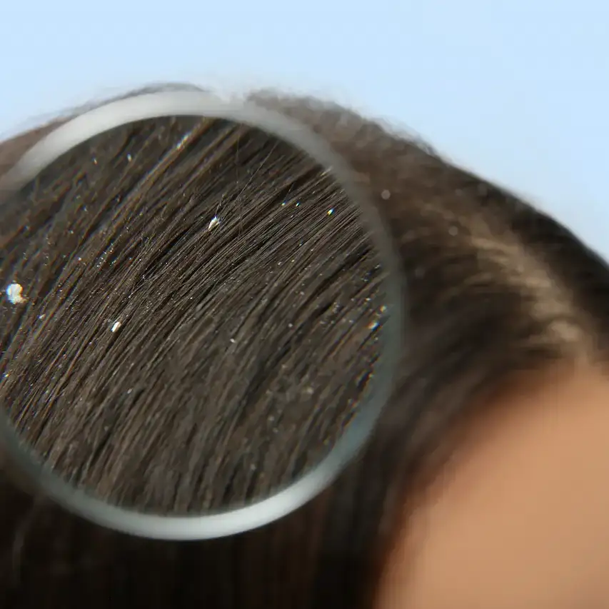 dandruff vs dry scalp — Hair Health Essentials
