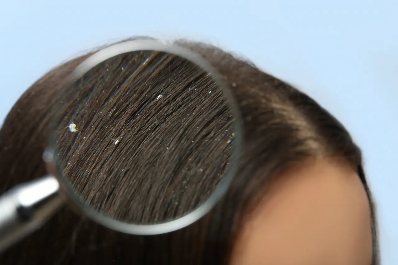 dandruff vs dry scalp — Hair Health Essentials